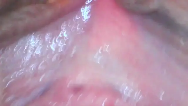 Poster: Milly17 endoscope play part